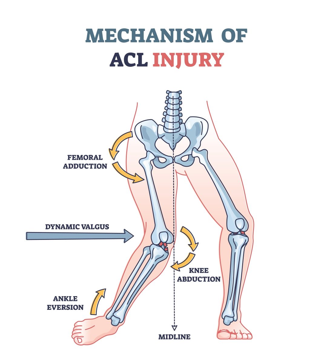 رایج ترین علت اسیب دیدگی رباطACL